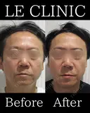 ピコトーニング+白玉点滴 after画像 サムネイル用