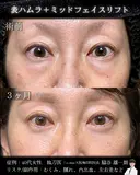 表ハムラ・ミッドフェイスリフト before画像 サムネイル用
