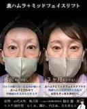 表ハムラ・ミッドフェイスリフト 90日後 サムネイル用