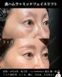 表ハムラ・ミッドフェイスリフト 90日後 サムネイル用