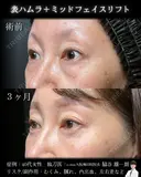 表ハムラ・ミッドフェイスリフト 90日後 サムネイル用