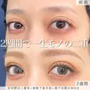MD式全切開法二重術+MD式眼瞼下垂手術+MD式眉下切開 before画像 サムネイル用