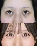 目の下のくまとり before画像 サムネイル用