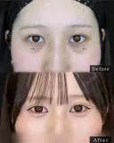 目の下のくまとり after画像 サムネイル用