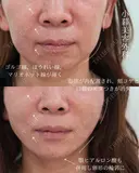 PCL糸リフト、顎ヒアルロン酸 before画像 サムネイル用