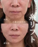 PCL糸リフト、顎ヒアルロン酸 0日後 サムネイル用