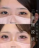 二重埋没 after画像 サムネイル用