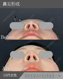 お顔のバランス整う🐻‍❄️💫鼻尖形成 after画像 サムネイル用
