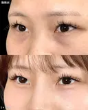 山本のクマ取り before画像 サムネイル用