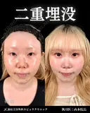 山本による🎀垢抜け二重🎀 after画像 サムネイル用
