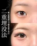 山本による🎀垢抜け二重🎀 after画像 サムネイル用