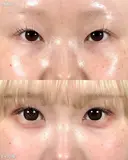 山本による🎀垢抜け二重🎀 before画像 サムネイル用