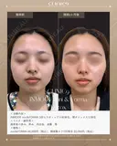 インモードMINI & FORMA エラボトックス before画像 サムネイル用