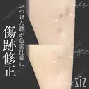 【傷跡修正】ぶつけた跡が色素沈着に after画像 サムネイル用