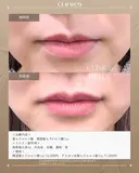 唇ヒアルロン酸　韓国製ヒアルロン酸1cc before画像 サムネイル用