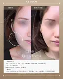 ヒアルロン酸×ボトックス×INMODE FORMA before画像 サムネイル用