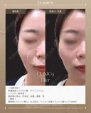鼻翼基部ヒアルロン酸 ボラックス1cc after画像 サムネイル用