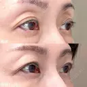 目の上のヒアルロン酸注射 before画像 サムネイル用