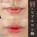 唇のヒアルロン酸注射 before画像 サムネイル用