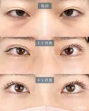二重切開法（全切開・部分切開） before画像 サムネイル用