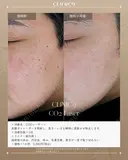 CO2レーザー　ホクロ・いぼ除去 before画像 サムネイル用