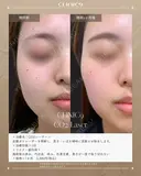 CO2レーザー　ホクロ・イボ除去 after画像 サムネイル用