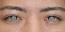 【20代男性・左右差を整える】二重埋没法（マイクロメソッド+α）（1ヶ月後） 30日後 サムネイル用