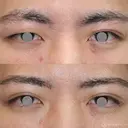 【20代男性・左右差を整える】二重埋没法（マイクロメソッド+α）（1ヶ月後） 30日後 サムネイル用