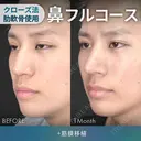 鼻フルコース［クローズ法］（鼻複合自家組織移植術 肋軟骨使用）＋筋膜移植 30日後 サムネイル用