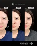 小顔脂肪吸引（頬・あご下）/クイックリフト8本 before画像 サムネイル用
