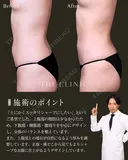 ポッコリお腹にバイバイ！吸引で叶えるヘルシー美腹筋✨｜お腹の360°脂肪吸引 after画像 サムネイル用
