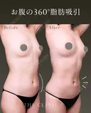 ポッコリお腹にバイバイ！吸引で叶えるヘルシー美腹筋✨｜お腹の360°脂肪吸引 before画像 サムネイル用