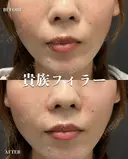 貴族フィラー before画像 サムネイル用