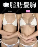コンデンスリッチファット豊胸 before画像 サムネイル用