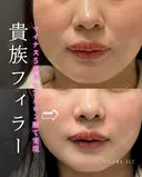 貴族フィラー before画像 サムネイル用