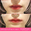 【スマイルリップ💋】唇ヒアルロン酸+口角ボト before画像 サムネイル用