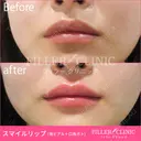 【スマイルリップ💋】唇ヒアルロン酸+口角ボト after画像 サムネイル用