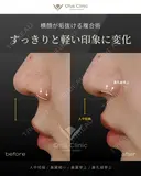 人中短縮・鼻翼縮小・鼻翼挙上・鼻孔縁挙上 before画像 サムネイル用