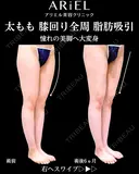 太もも　膝全周　脂肪吸引 180日後 サムネイル用