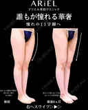 太もも　膝全周　脂肪吸引 before画像 サムネイル用