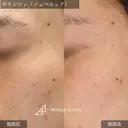 ポテンツァ ドラッグデリバリー（ジュベルック） before画像 サムネイル用
