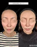 山本による🎀糸リフト🎀 after画像 サムネイル用