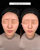 山本による🎀糸リフト🎀 before画像 サムネイル用