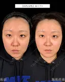 山本による🎀糸リフト🎀 after画像 サムネイル用