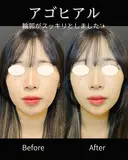 アゴヒアル 0日後 サムネイル用