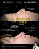 【鼻整形】鼻尖形成クローズ法＋耳介軟骨移植 before画像 サムネイル用