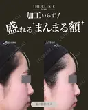 盛れる額GET✨｜顔の脂肪注入（額・こめかみ） before画像 サムネイル用