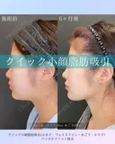 クイック小顔脂肪吸引・バッカルファット除去 before画像 サムネイル用