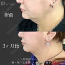 【ミニ脂肪吸引】他院修正から若見え before画像 サムネイル用