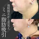 【ミニ脂肪吸引】他院修正から若見え after画像 サムネイル用